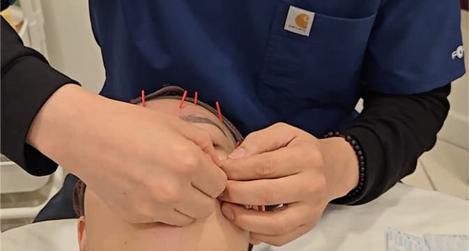 facial acupuncture