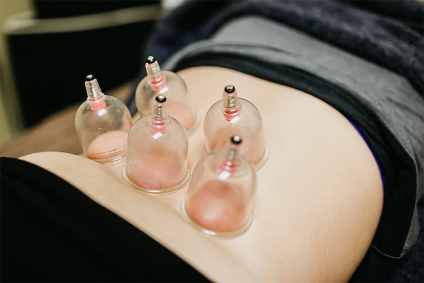 cupping 1