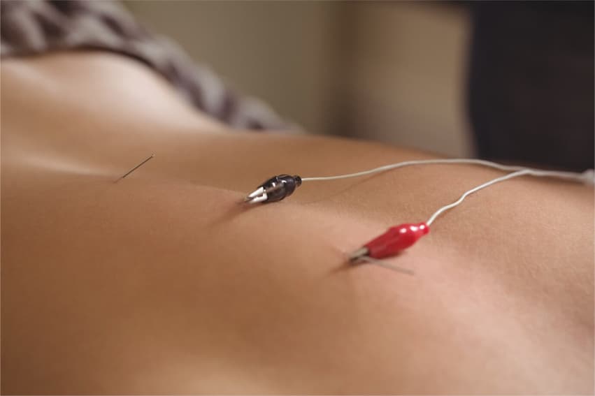 electro acupuncture 1